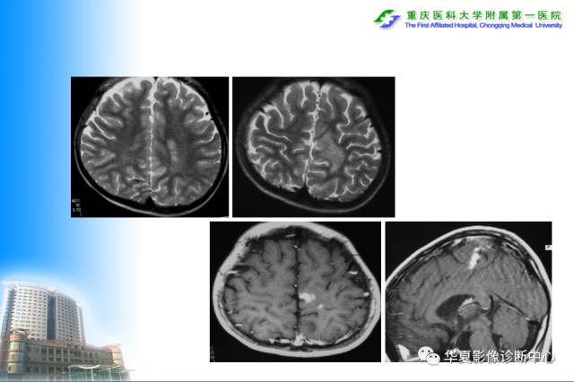 【PPT】自身免疫性脑病的影像学诊断