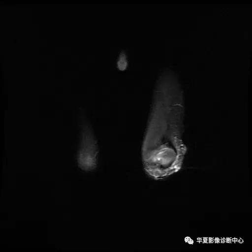 【病例】Klippel-Trenaunay综合征(K.T.综合征)1例MR 【病例】Klippel-Trenaunay综合征(K.T.综合征)1例MR