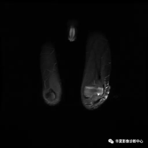 【病例】Klippel-Trenaunay综合征(K.T.综合征)1例MR 【病例】Klippel-Trenaunay综合征(K.T.综合征)1例MR