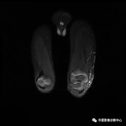 【病例】Klippel-Trenaunay综合征(K.T.综合征)1例MR 【病例】Klippel-Trenaunay综合征(K.T.综合征)1例MR