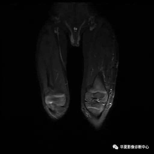 【病例】Klippel-Trenaunay综合征(K.T.综合征)1例MR 【病例】Klippel-Trenaunay综合征(K.T.综合征)1例MR