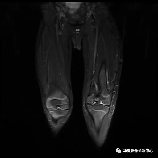 【病例】Klippel-Trenaunay综合征(K.T.综合征)1例MR 【病例】Klippel-Trenaunay综合征(K.T.综合征)1例MR