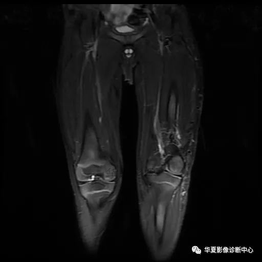 【病例】Klippel-Trenaunay综合征(K.T.综合征)1例MR 【病例】Klippel-Trenaunay综合征(K.T.综合征)1例MR