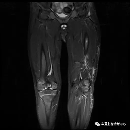 【病例】Klippel-Trenaunay综合征(K.T.综合征)1例MR 【病例】Klippel-Trenaunay综合征(K.T.综合征)1例MR