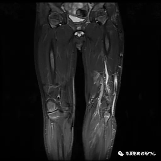 【病例】Klippel-Trenaunay综合征(K.T.综合征)1例MR 【病例】Klippel-Trenaunay综合征(K.T.综合征)1例MR