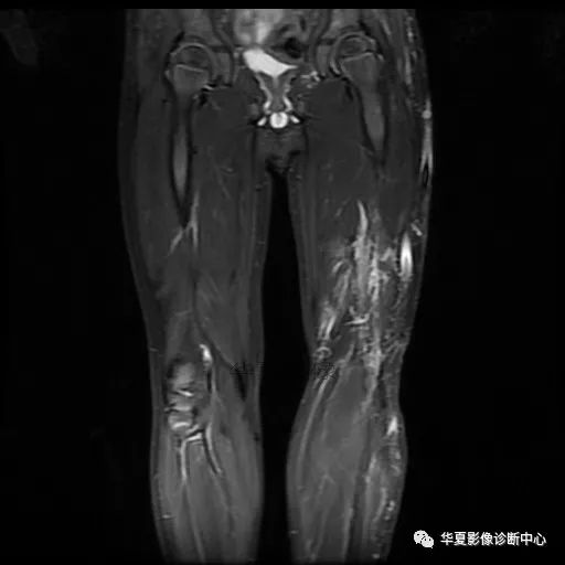 【病例】Klippel-Trenaunay综合征(K.T.综合征)1例MR 【病例】Klippel-Trenaunay综合征(K.T.综合征)1例MR