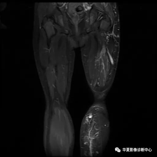 【病例】Klippel-Trenaunay综合征(K.T.综合征)1例MR 【病例】Klippel-Trenaunay综合征(K.T.综合征)1例MR