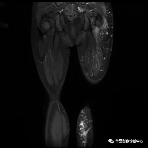 【病例】Klippel-Trenaunay综合征(K.T.综合征)1例MR 【病例】Klippel-Trenaunay综合征(K.T.综合征)1例MR