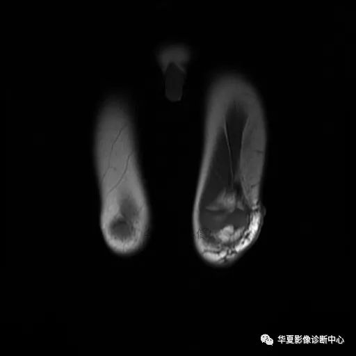 【病例】Klippel-Trenaunay综合征(K.T.综合征)1例MR 【病例】Klippel-Trenaunay综合征(K.T.综合征)1例MR