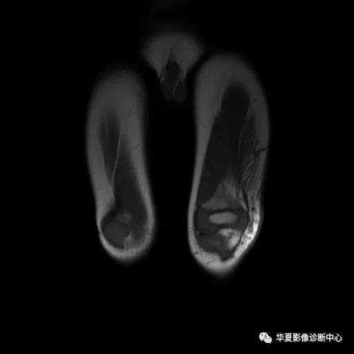 【病例】Klippel-Trenaunay综合征(K.T.综合征)1例MR 【病例】Klippel-Trenaunay综合征(K.T.综合征)1例MR