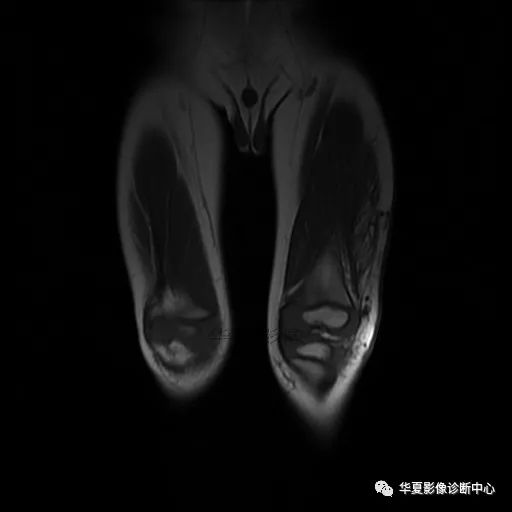 【病例】Klippel-Trenaunay综合征(K.T.综合征)1例MR 【病例】Klippel-Trenaunay综合征(K.T.综合征)1例MR
