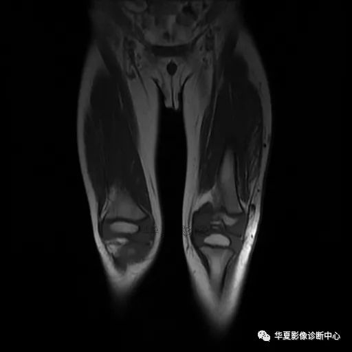【病例】Klippel-Trenaunay综合征(K.T.综合征)1例MR 【病例】Klippel-Trenaunay综合征(K.T.综合征)1例MR
