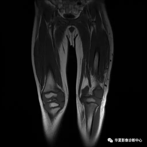 【病例】Klippel-Trenaunay综合征(K.T.综合征)1例MR 【病例】Klippel-Trenaunay综合征(K.T.综合征)1例MR