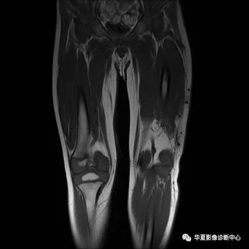 【病例】Klippel-Trenaunay综合征(K.T.综合征)1例MR 【病例】Klippel-Trenaunay综合征(K.T.综合征)1例MR