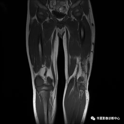 【病例】Klippel-Trenaunay综合征(K.T.综合征)1例MR 【病例】Klippel-Trenaunay综合征(K.T.综合征)1例MR