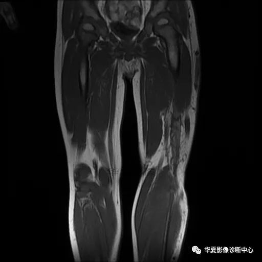 【病例】Klippel-Trenaunay综合征(K.T.综合征)1例MR 【病例】Klippel-Trenaunay综合征(K.T.综合征)1例MR