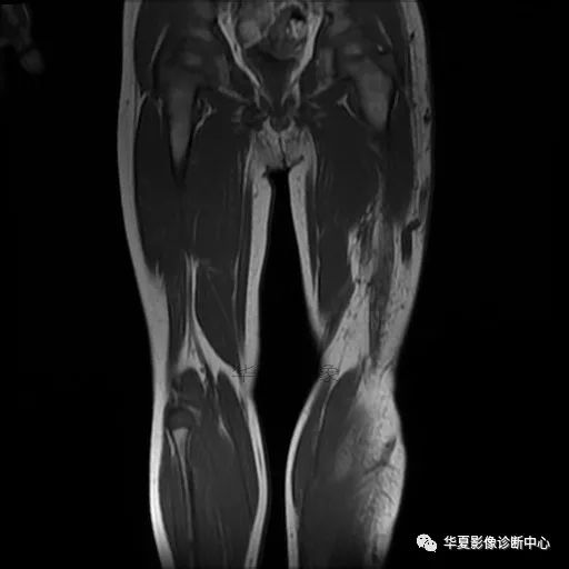 【病例】Klippel-Trenaunay综合征(K.T.综合征)1例MR 【病例】Klippel-Trenaunay综合征(K.T.综合征)1例MR