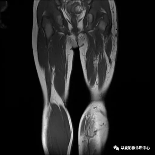 【病例】Klippel-Trenaunay综合征(K.T.综合征)1例MR 【病例】Klippel-Trenaunay综合征(K.T.综合征)1例MR