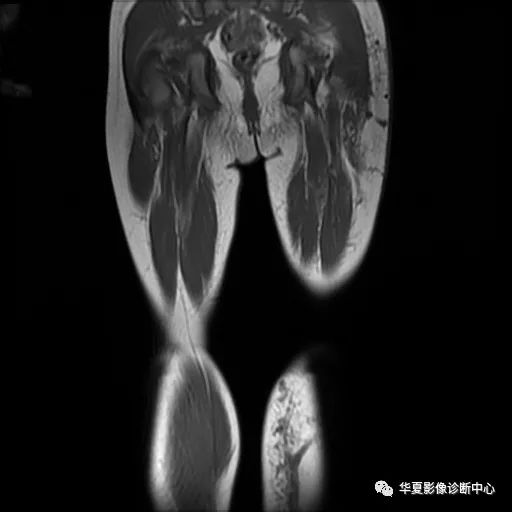 【病例】Klippel-Trenaunay综合征(K.T.综合征)1例MR 【病例】Klippel-Trenaunay综合征(K.T.综合征)1例MR
