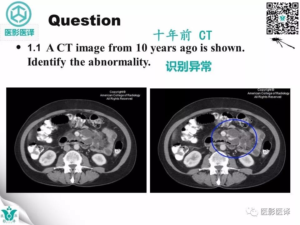 【病例】肠系膜空洞性淋巴结综合症1例CT