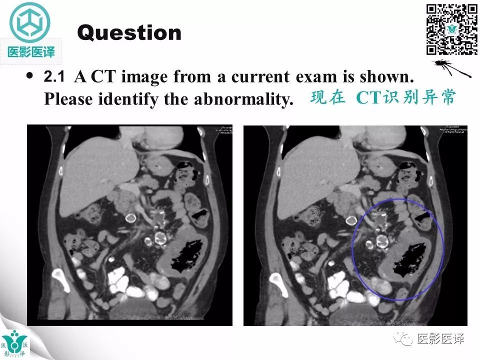 【病例】肠系膜空洞性淋巴结综合症1例CT