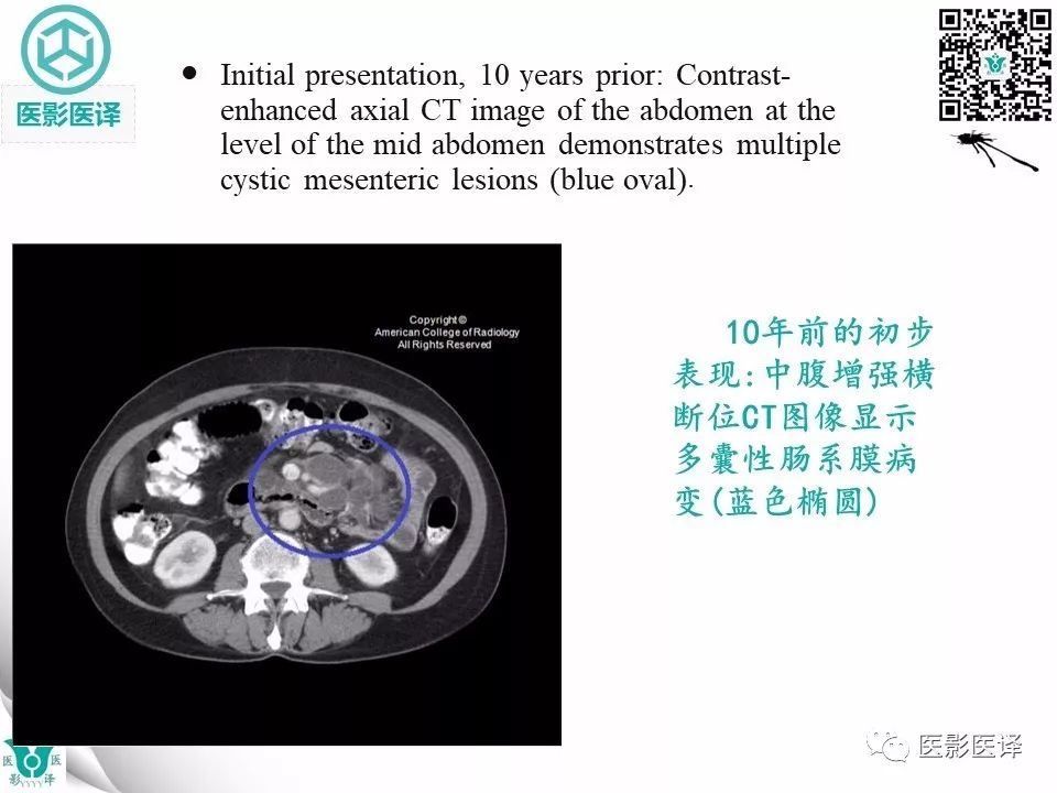 【病例】肠系膜空洞性淋巴结综合症1例CT