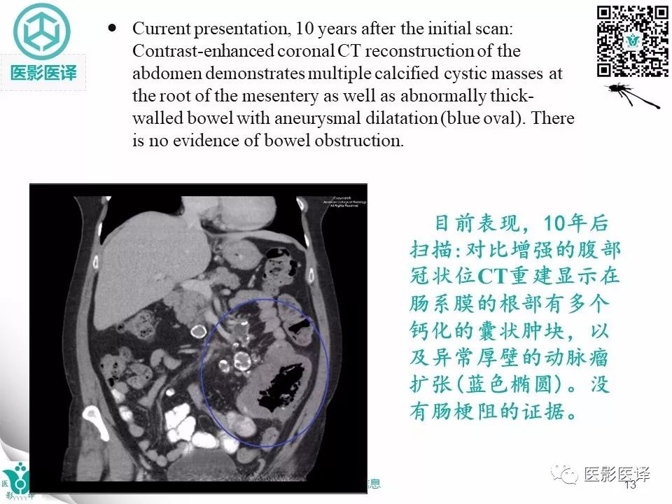 【病例】肠系膜空洞性淋巴结综合症1例CT