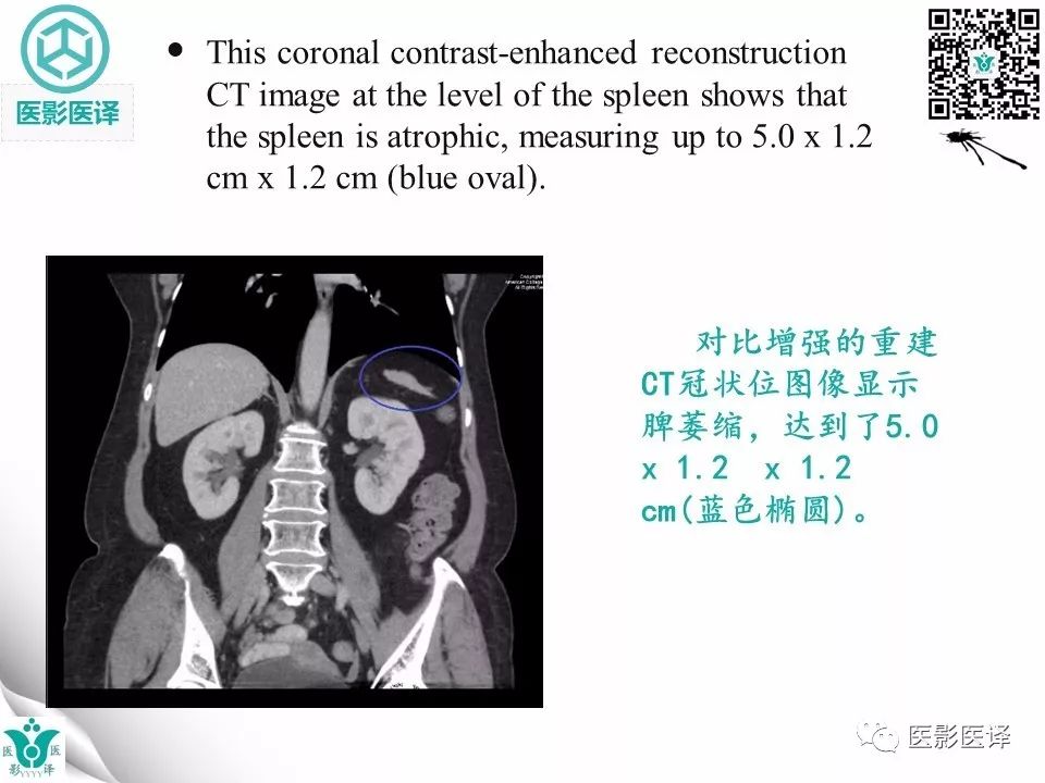 【病例】肠系膜空洞性淋巴结综合症1例CT
