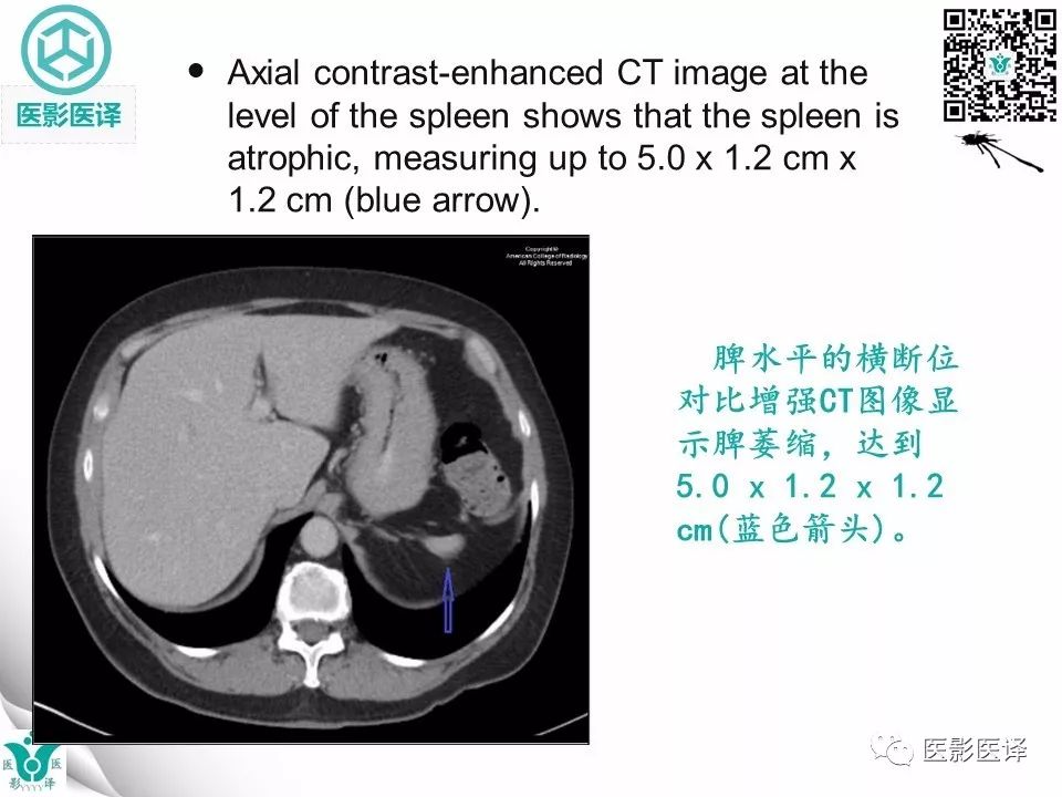 【病例】肠系膜空洞性淋巴结综合症1例CT