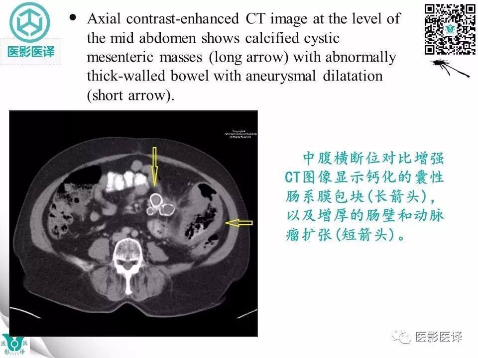 【病例】肠系膜空洞性淋巴结综合症1例CT