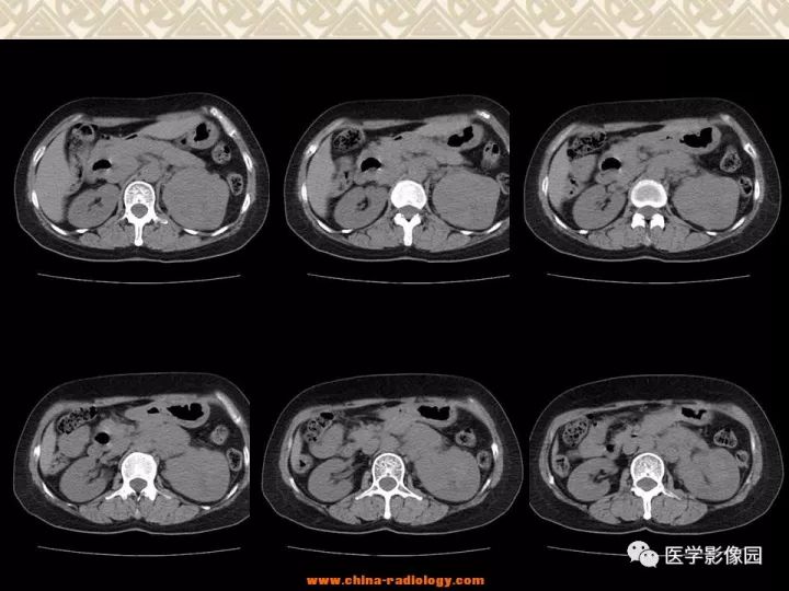 【病例】左肾嫌色细胞癌1例CT影像表现 【病例】左肾嫌色细胞癌1例CT影像表现