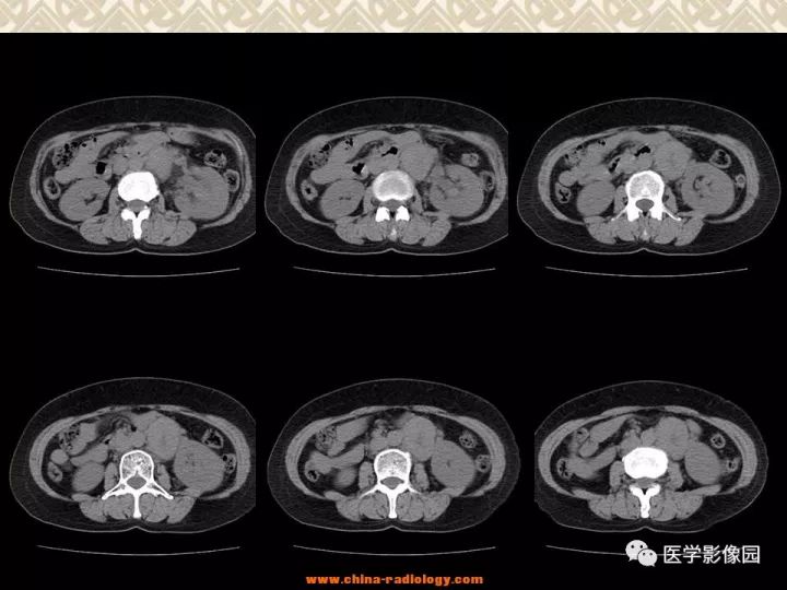 【病例】左肾嫌色细胞癌1例CT影像表现 【病例】左肾嫌色细胞癌1例CT影像表现