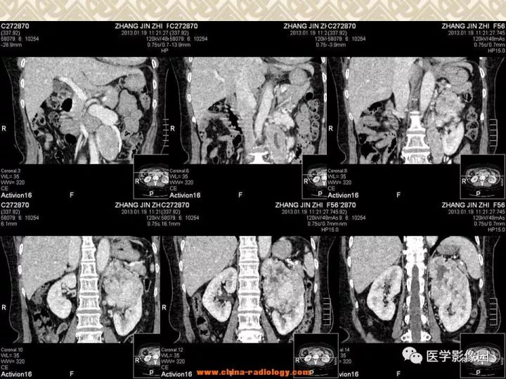 【病例】左肾嫌色细胞癌1例CT影像表现 【病例】左肾嫌色细胞癌1例CT影像表现