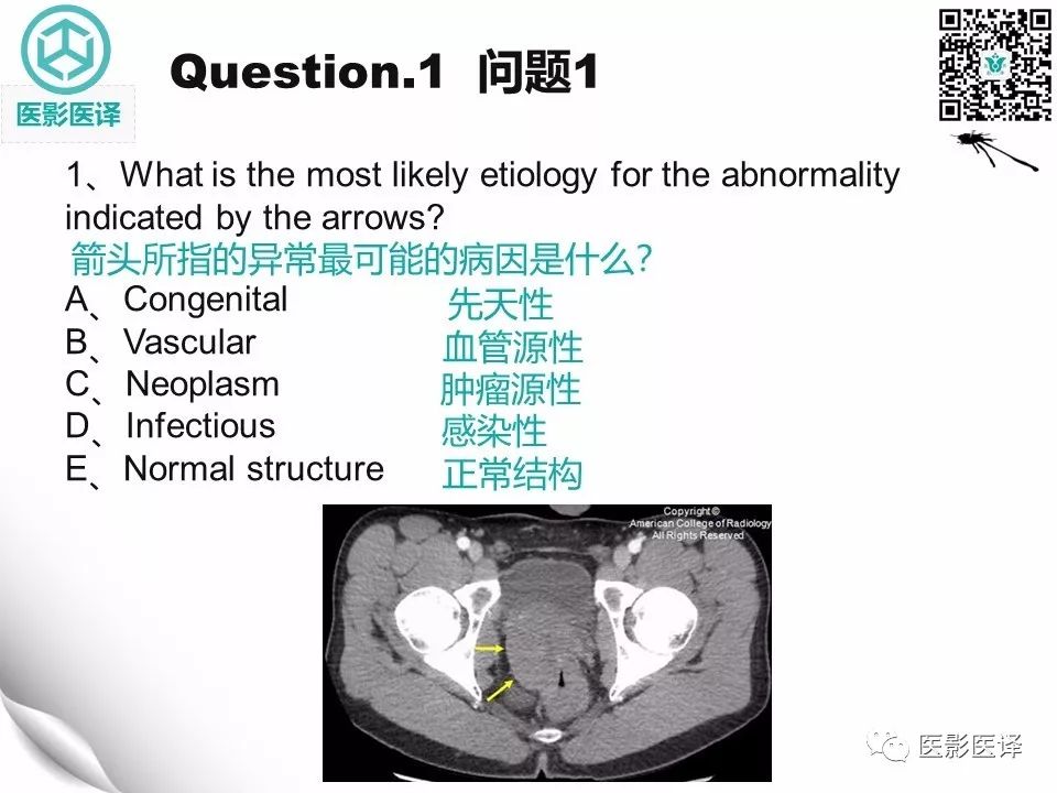 【病例】直肠间质瘤1例CT及MR
