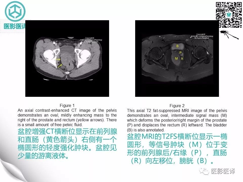 【病例】直肠间质瘤1例CT及MR