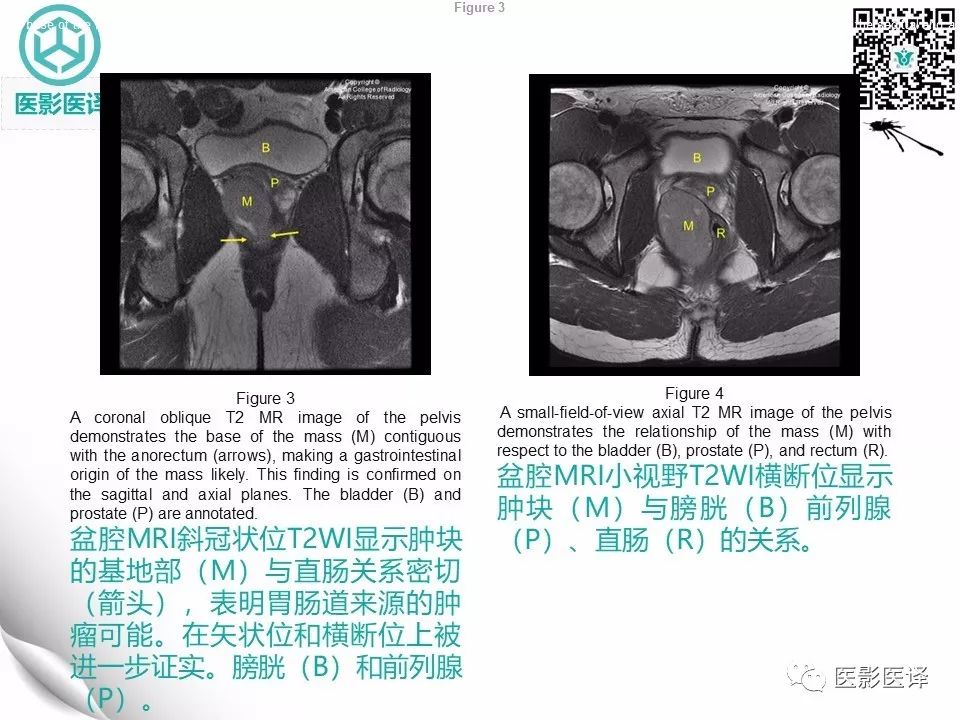 【病例】直肠间质瘤1例CT及MR