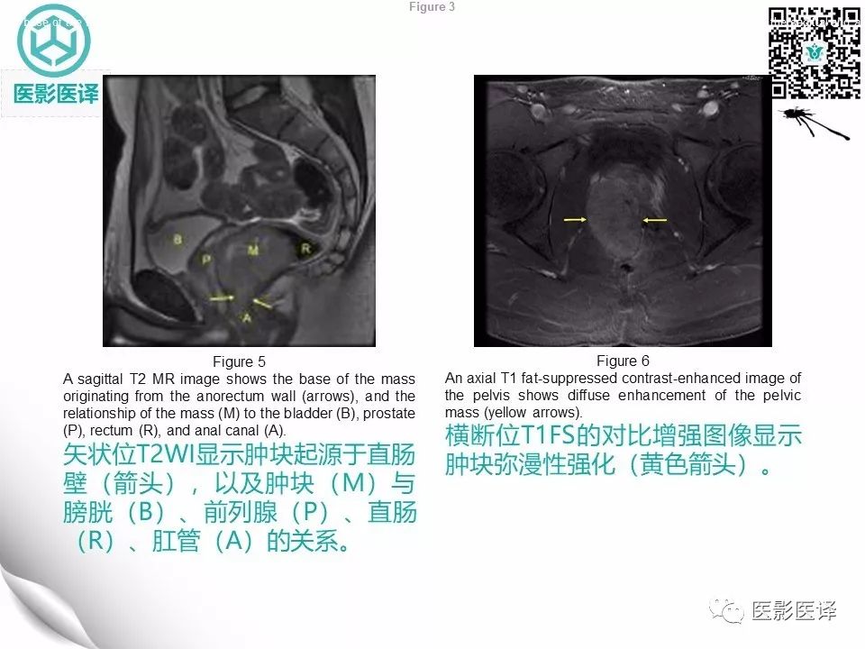 【病例】直肠间质瘤1例CT及MR