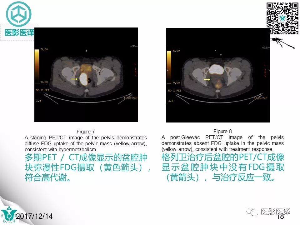 【病例】直肠间质瘤1例CT及MR