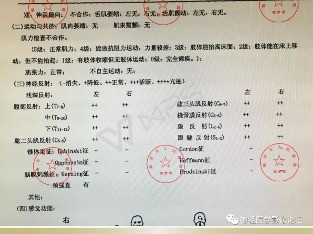 【病例】丘脑对称性病变之乙脑1例CT及MR