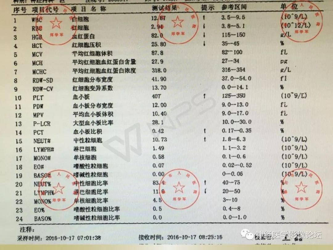 【病例】丘脑对称性病变之乙脑1例CT及MR