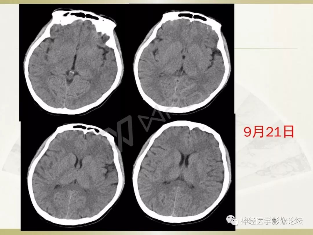 【病例】丘脑对称性病变之乙脑1例CT及MR