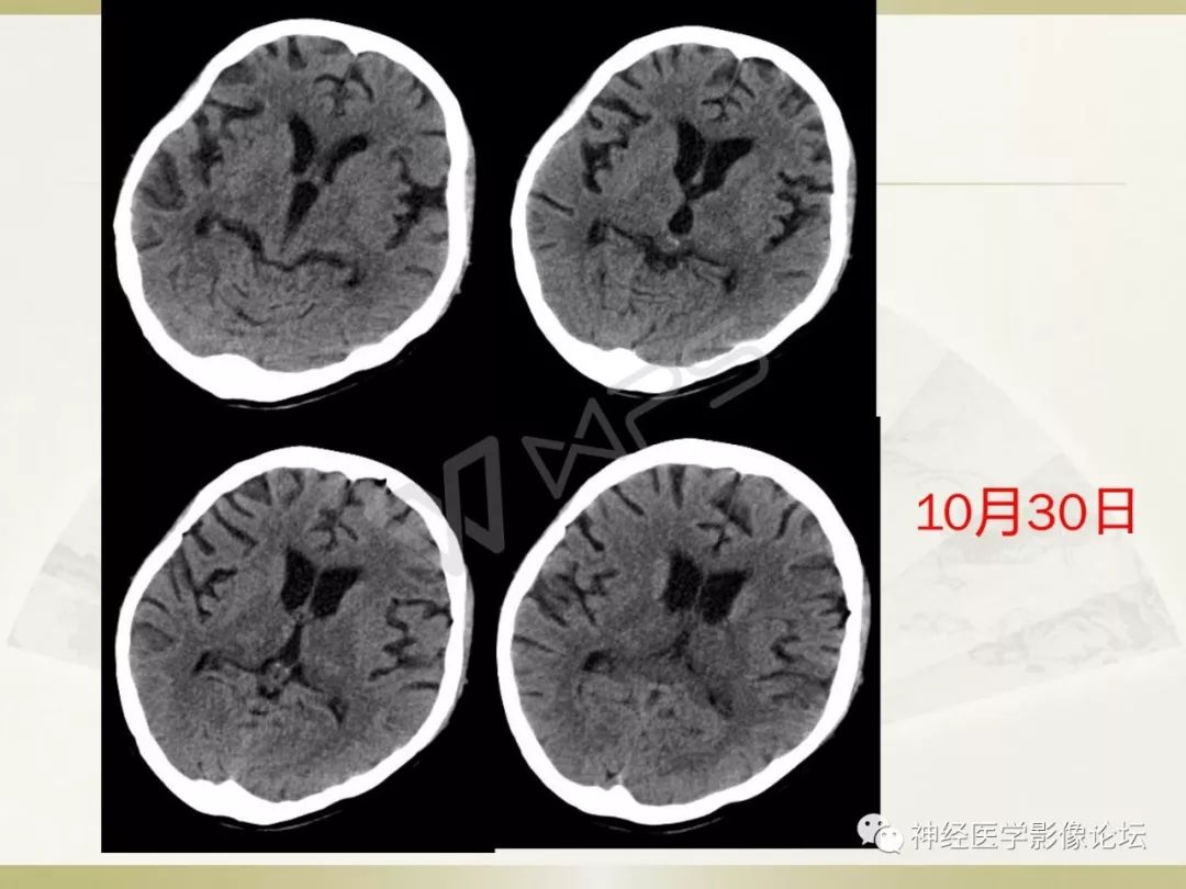 【病例】丘脑对称性病变之乙脑1例CT及MR