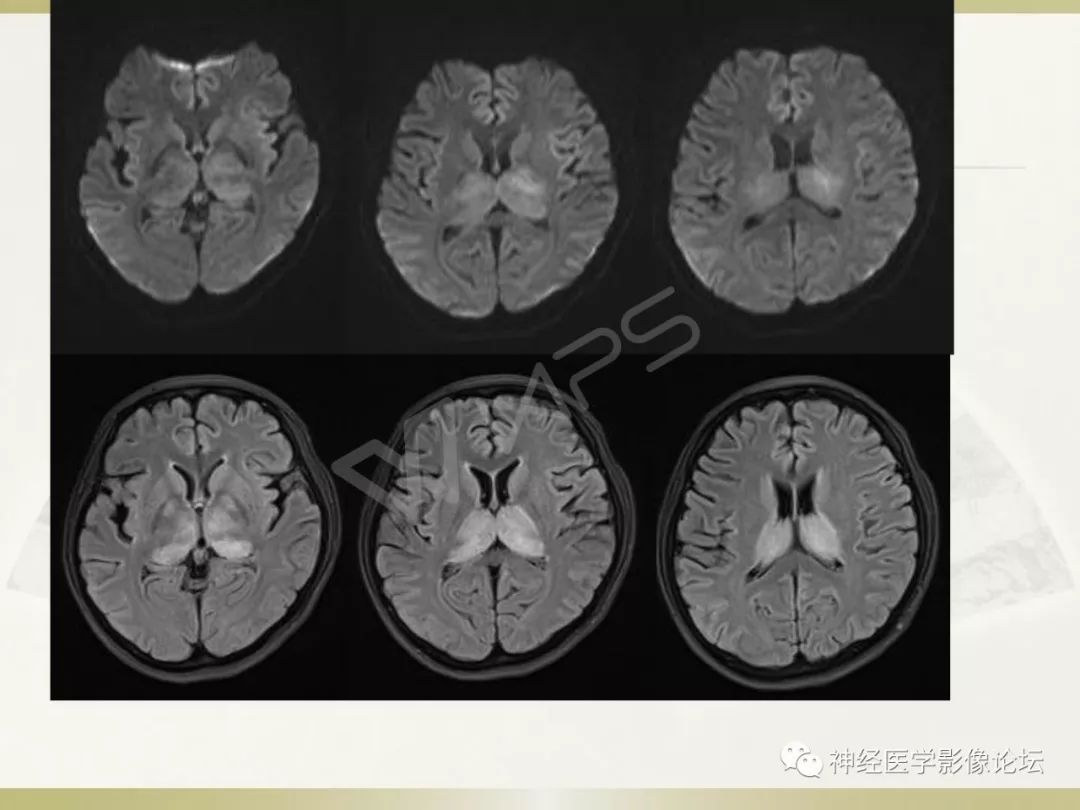 【病例】丘脑对称性病变之乙脑1例CT及MR