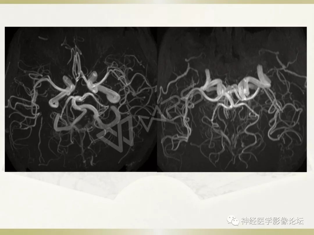 【病例】丘脑对称性病变之乙脑1例CT及MR
