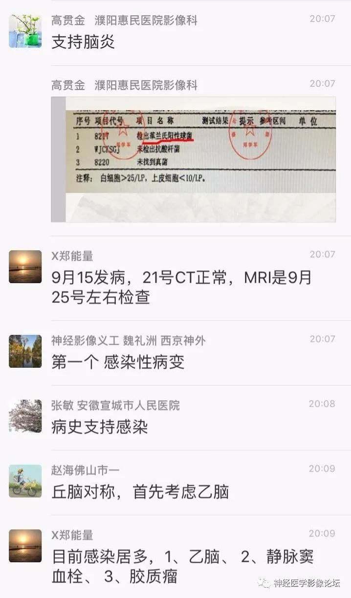 【病例】丘脑对称性病变之乙脑1例CT及MR