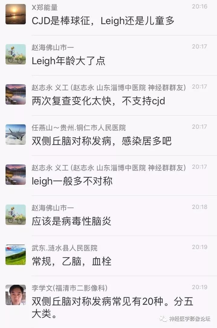 【病例】丘脑对称性病变之乙脑1例CT及MR