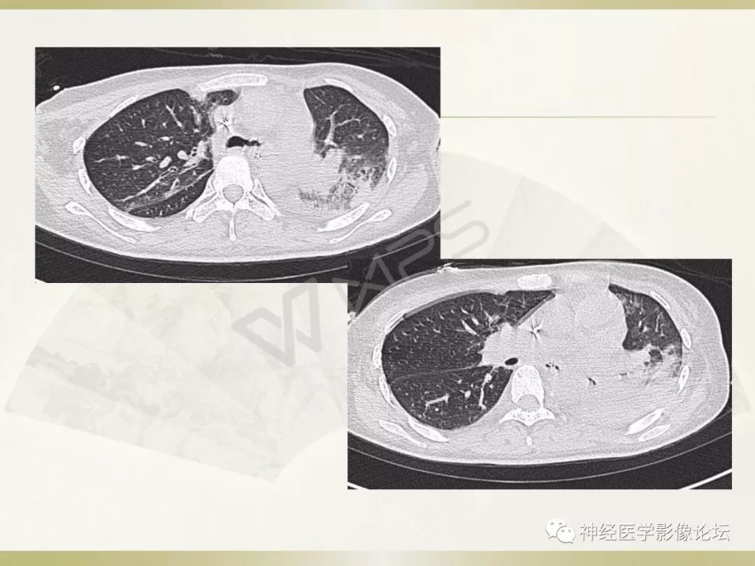 【病例】丘脑对称性病变之乙脑1例CT及MR