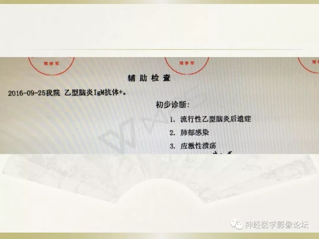 【病例】丘脑对称性病变之乙脑1例CT及MR