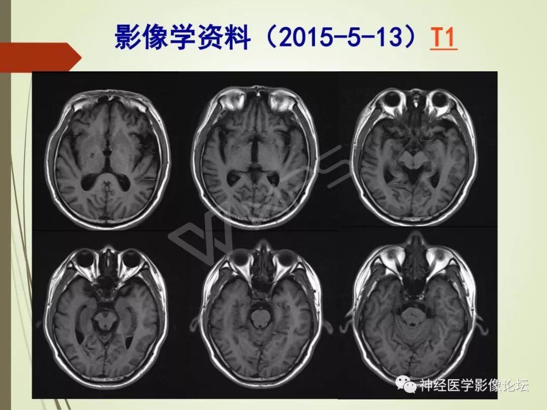 【病例】丘脑对称性病变之硬脑膜动静脉瘘并丘脑-基底节区静脉性脑梗塞1例CT及MR