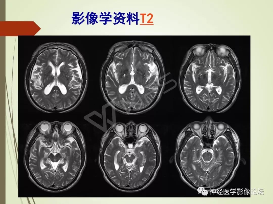 【病例】丘脑对称性病变之硬脑膜动静脉瘘并丘脑-基底节区静脉性脑梗塞1例CT及MR